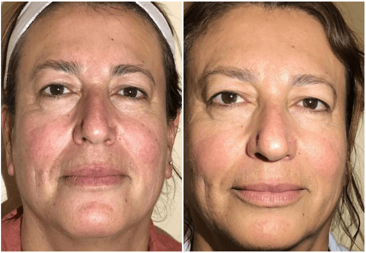 halo-laser-westlake-village