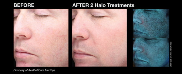 halo_before_and_afters_7_new Camarillo halo_before_and_afters_7_new Camarillo