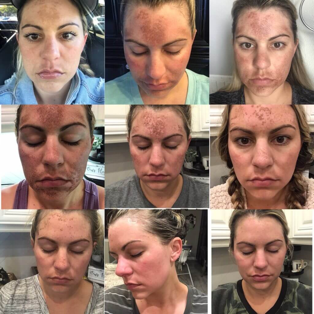 Top 94+ Pictures Day 3 Halo Laser Recovery Pictures Sharp