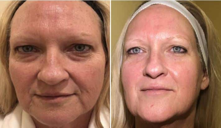 How Much Does The Halo Laser Treatment Cost Camarillo Halo Laser 