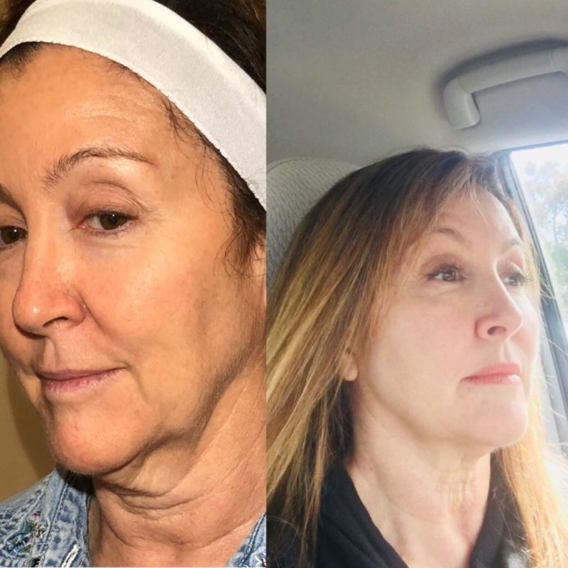 SkinTyte Resu;ts Camarillo Skin Tightening Westlake Village