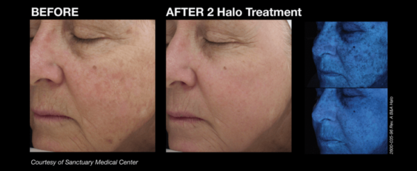 Halo Laser Camarillo Halo Laser Camarillo
