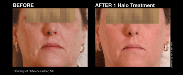 Halo Laser Camarillo Halo Laser Camarillo