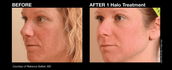 Halo Laser Camarillo Halo Laser Camarillo