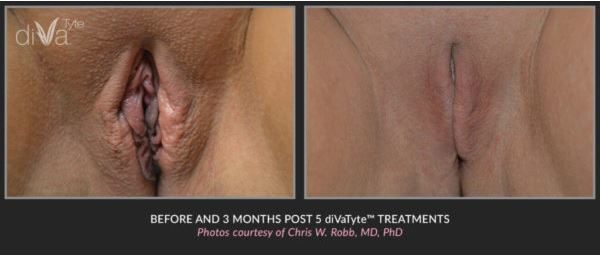 Vaginal Rejuvenation Camarillo Vaginal Rejuvenation Camarillo