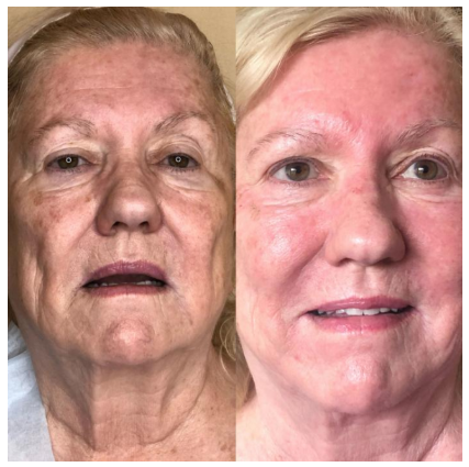 halo laser skin resurfacing camarillo