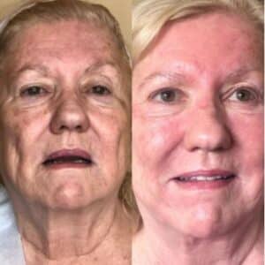 Laser skin resurfacing Camarillo