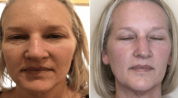BroadBand-Light-Laser-Treatment-camarillo