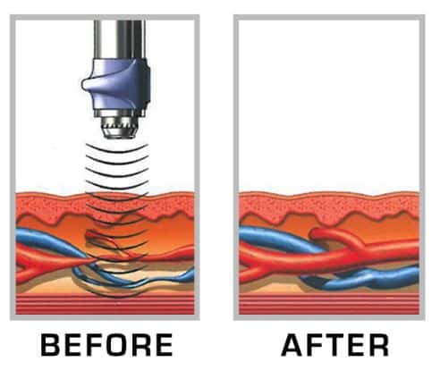 Gainswave-Before-After-Camarillo