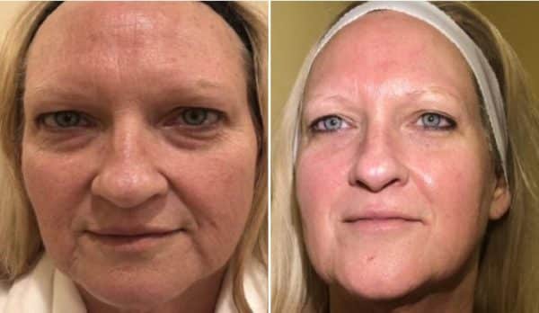 How-Much-Halo-Laser-Treatment-Cost-Camarillo