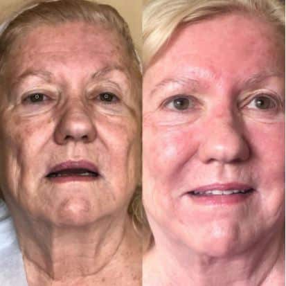 Laser-skin-resurfacing-Camarillo