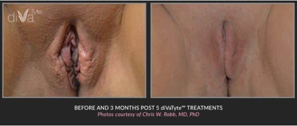 Vaginal-Rejuvenation-Camarillo