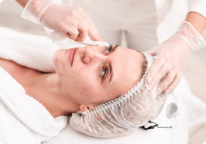 Acne Facial