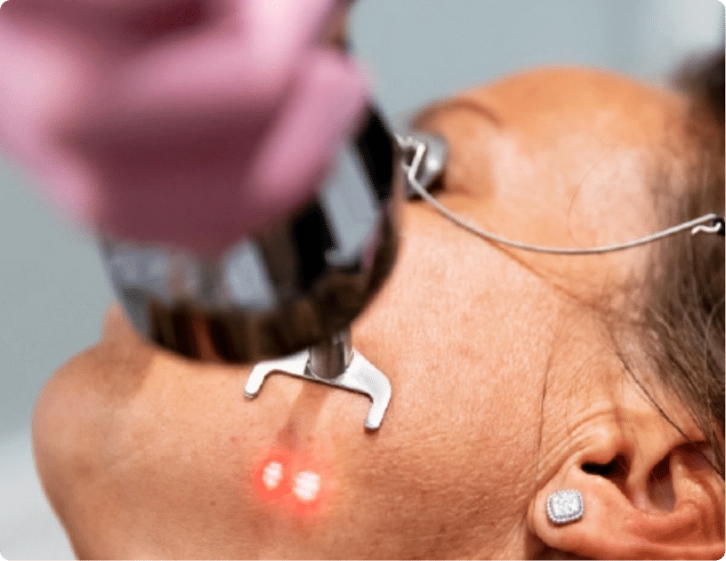 ProFractional Laser